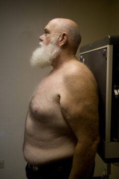 Harold Lane, a coal miner for two decades, comes to the black lung clinic for his x-rays. The inhalation and accumulation of coal dust into the lungs increases the risk of developing emphysema and chronic bronchitis. Coal dust can also increase the risk of developing chronic obstructive pulmonary disease.