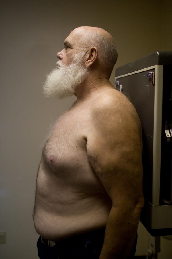 Harold Lane, a coal miner for two decades, comes to the black lung clinic for his x-rays. The inhalation and accumulation of coal dust into the lungs increases the risk of developing emphysema and chronic bronchitis. Coal dust can also increase the risk of developing chronic obstructive pulmonary disease.