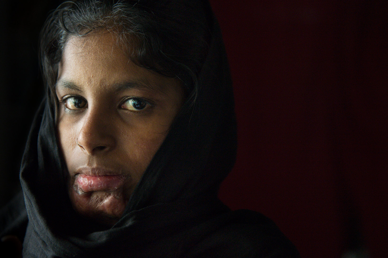 "I never thought I would see 2014, I am so happy I have another chance." 17 year-old Deepa's marriage began by being abducted and raped and ended in a hospital bed after she was set alight "accidentally" by her husband. Her mother-in-law had doused her in kerosene during an argument about dowry.